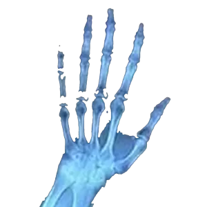 An x-ray of a hand